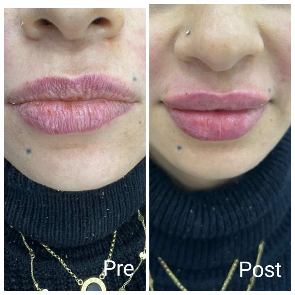 Lip fillers at Nadara Clinic